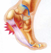 plantar fasciitis