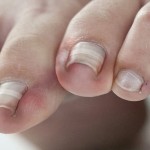 ingrown toe nail bsbrace