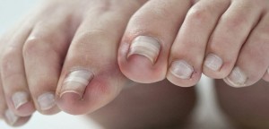 Photo Of A Person With Nail Fungus