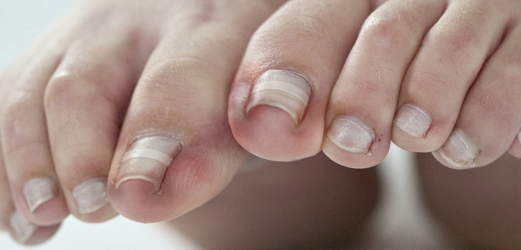 nail fungus