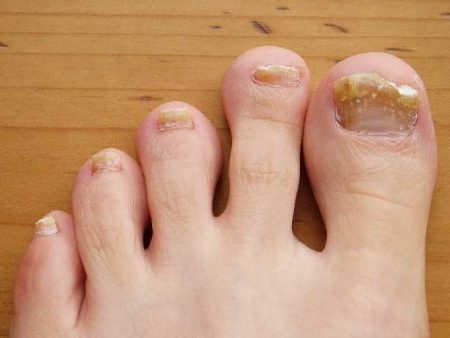 photo of a person with toenail fungus