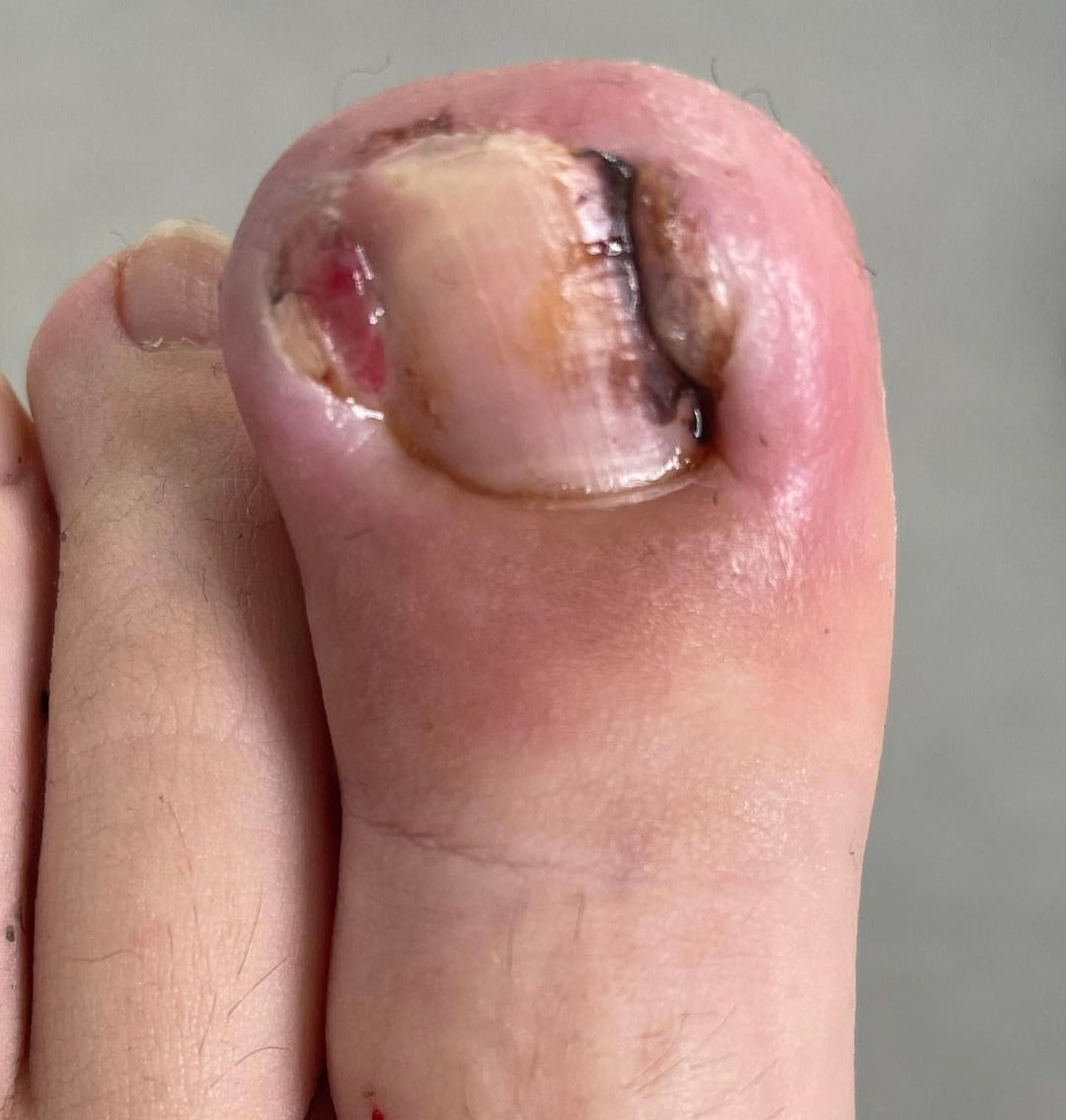 Ingrown toe Nails  Cheltenham Podiatry