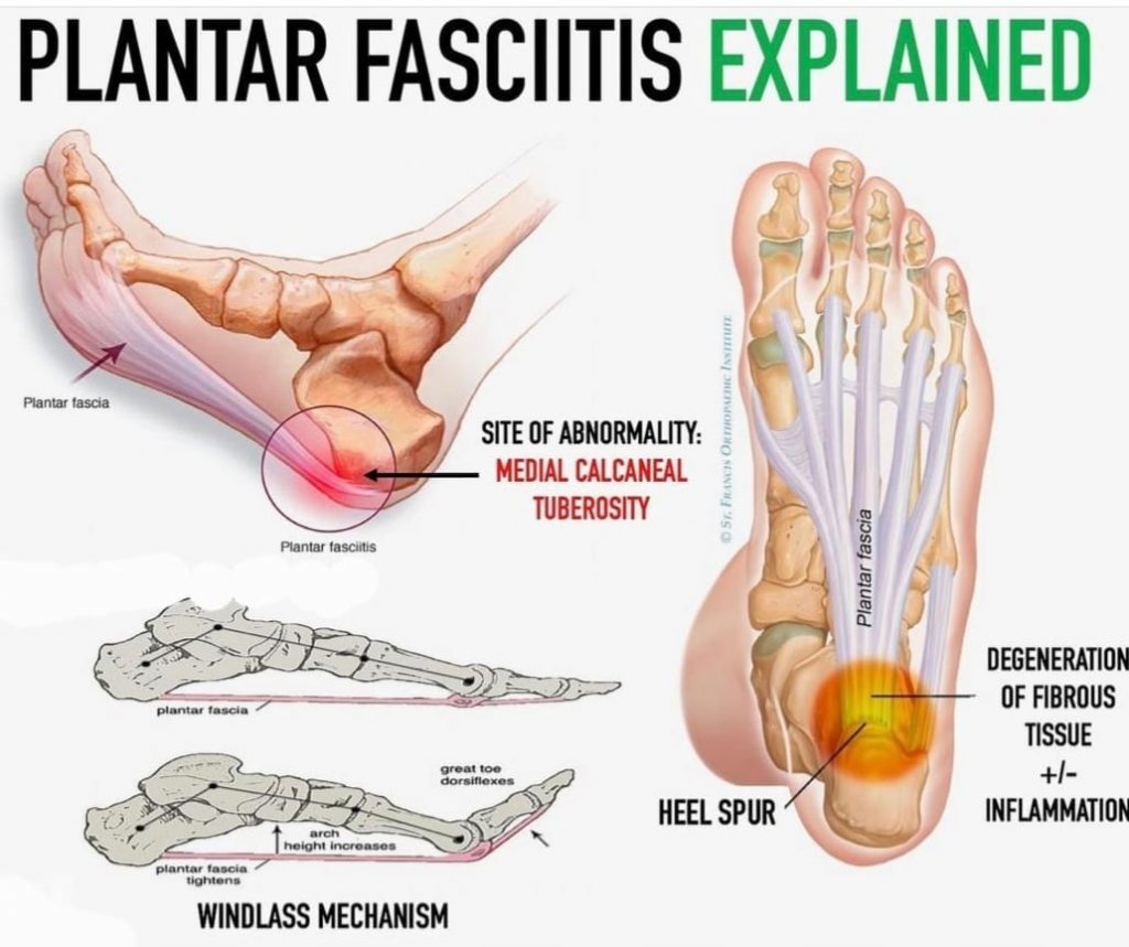 TCM Tips on How to get rid of Heel Pain (Plantar Fasciitis) – PULSE TCM