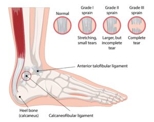 Lateral ankle sprain