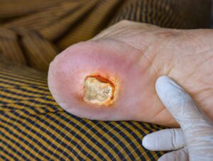 ulcer clinic