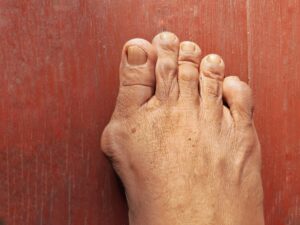 bunions