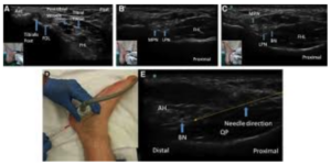 Nerve Entrapments