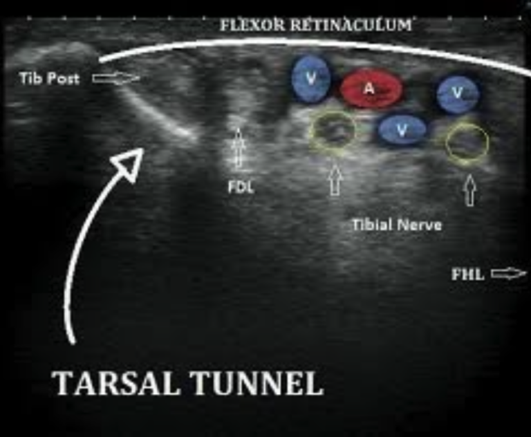 Nerve Hydrodissection