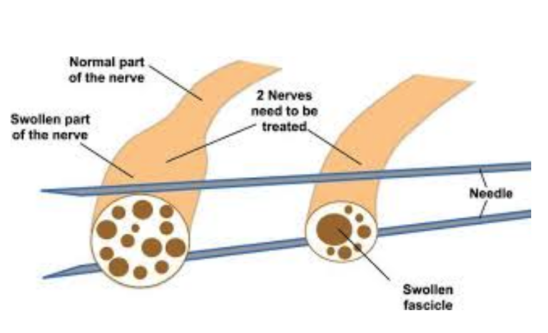 Nerve Hydrodissection