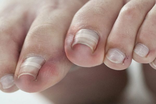 Photo Of A Person With Nail Fungus