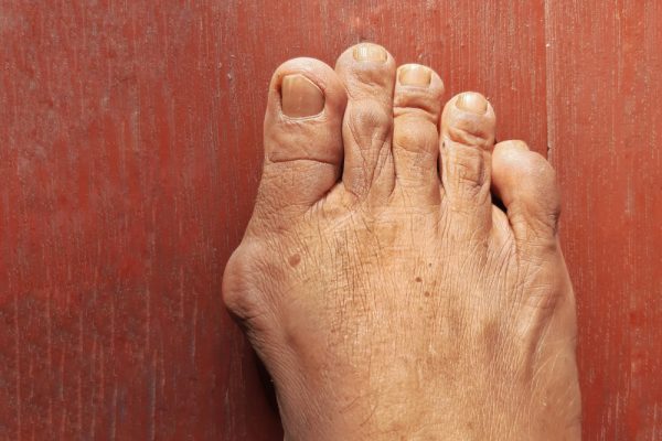 common foot conditions