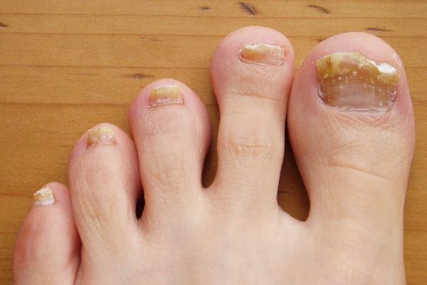 person with toenail fungus